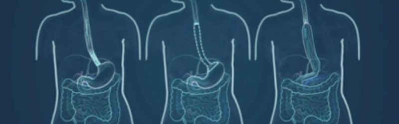 Dietary changes after Oesophagectomy - What can I expect?