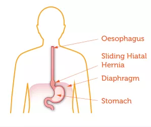 Hiatus Hernia