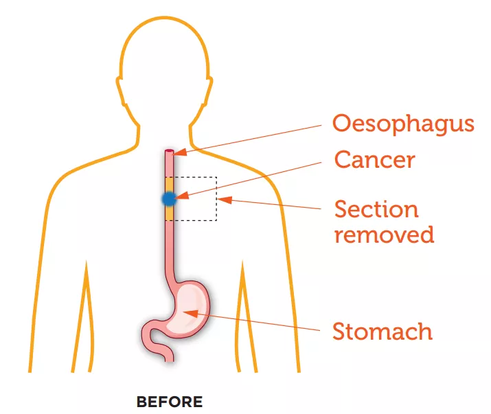 Oesophageal Cancer