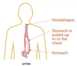 Oesophageal Cancer
