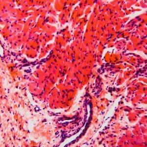 barrett's oesophagus