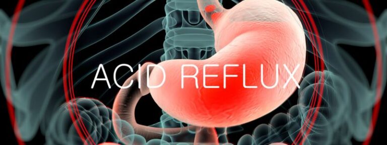 treatement for acid reflux